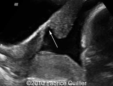 measuring uterine scar thickness on ultrasound|uterine scar dehiscence ultrasound.